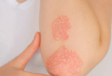 Psoriasis: Causes, Symptoms, and Treatment