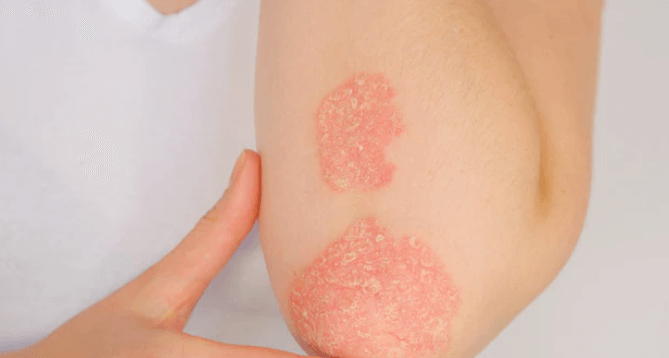 Psoriasis: Causes, Symptoms, and Treatment