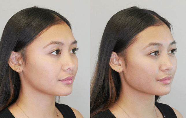 Journey to a Sculpted Jawline: Non-Surgical Solutions that Work