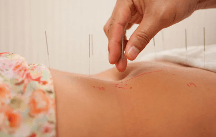 Acupuncture Services